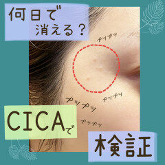 【検証】【鎮静・即効性】シカクリーム【ＶＴ】CICA【肌荒れ】プツプツ何日で消えるか観察日記。